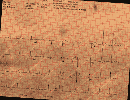 Normal ECG — PTB-XL