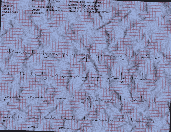 Normal ECG — PTB-XL