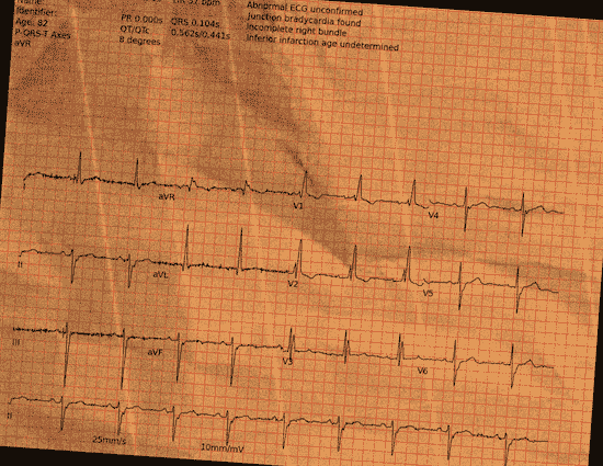 Normal ECG — PTB-XL