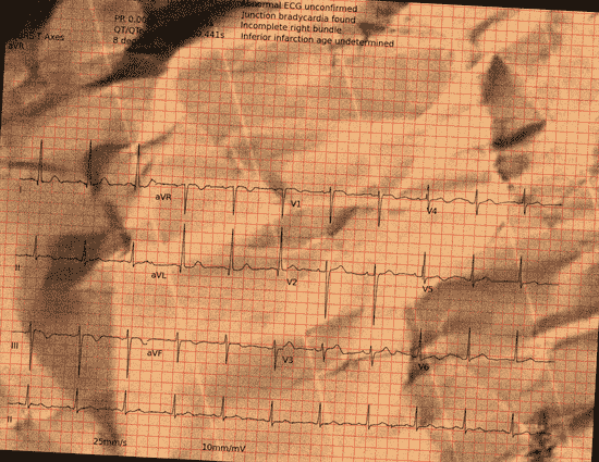 Normal ECG — PTB-XL