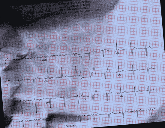 Normal ECG — PTB-XL