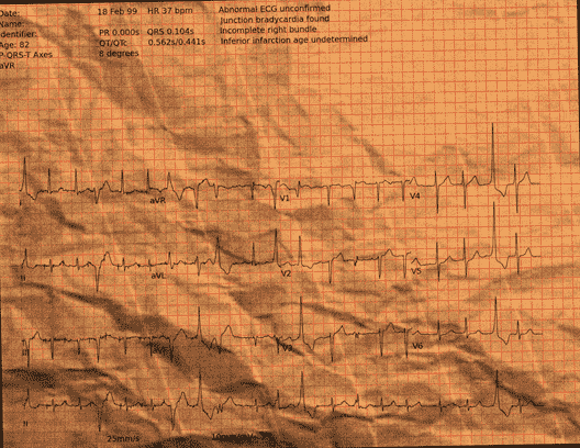 Normal ECG — PTB-XL