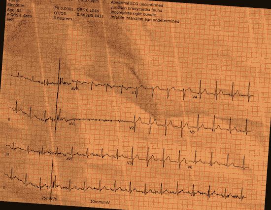 Normal ECG — PTB-XL