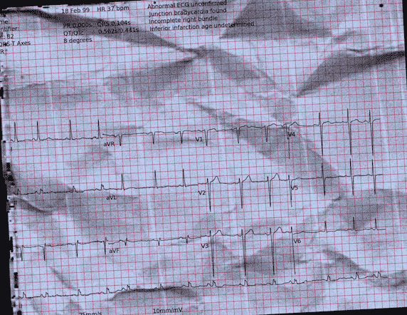 Normal ECG — PTB-XL
