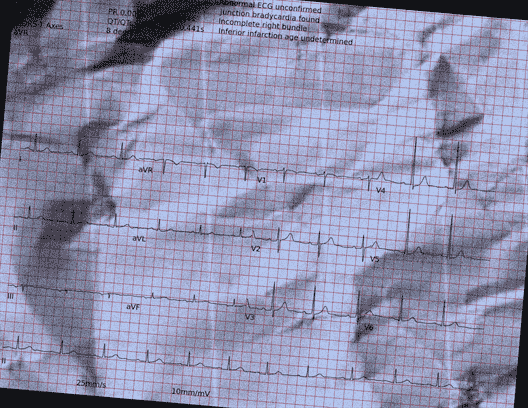 Normal ECG — PTB-XL