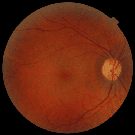 No Diabetic Retinopathy — MESSIDOR-2