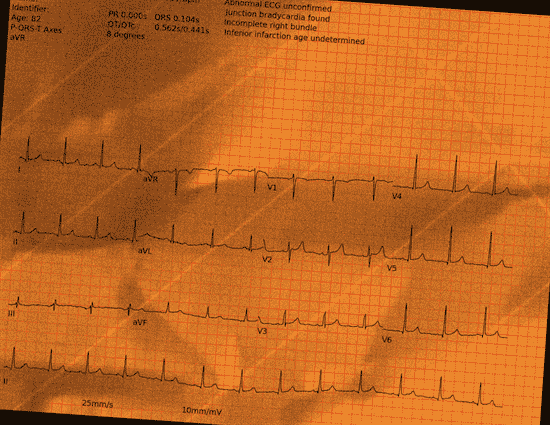 Normal ECG — PTB-XL
