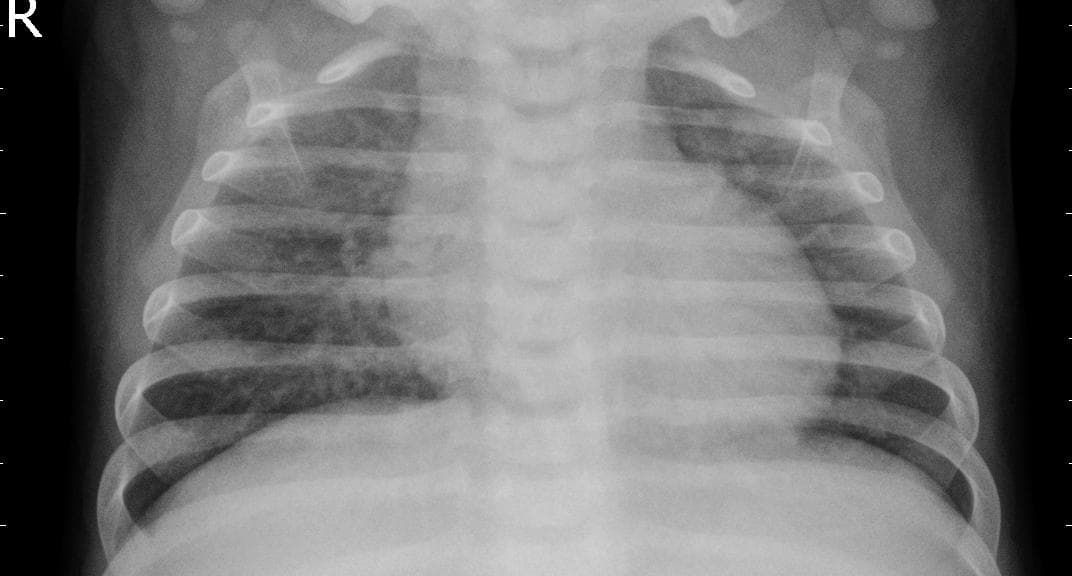 Pneumonia — NIH Chest X-ray14
