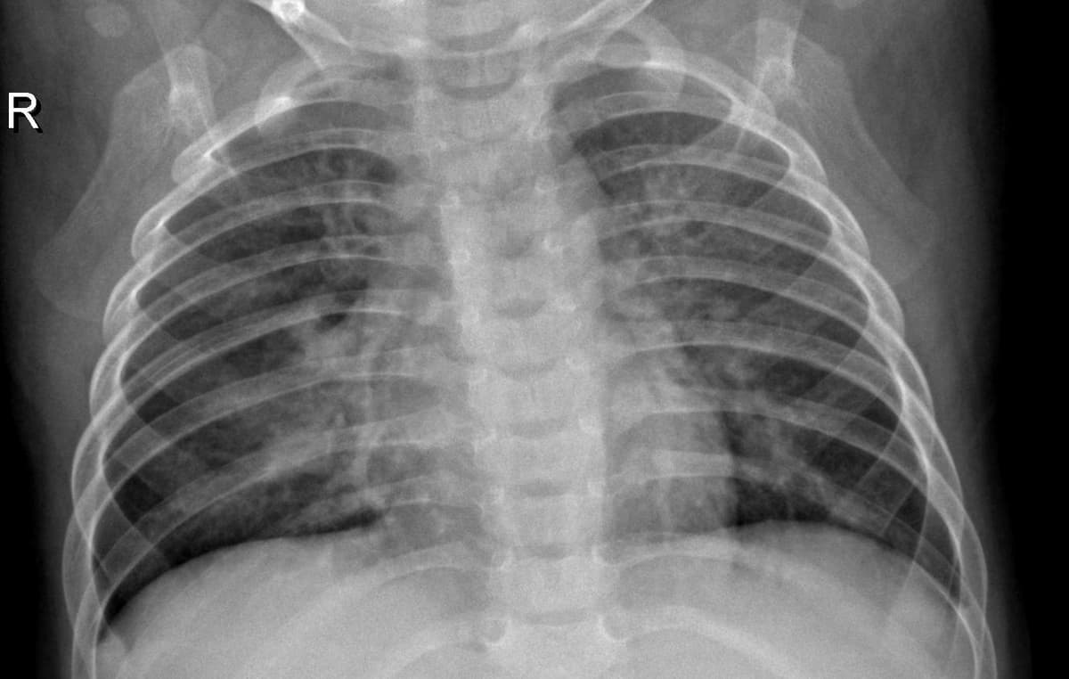 Pneumonia — NIH Chest X-ray14