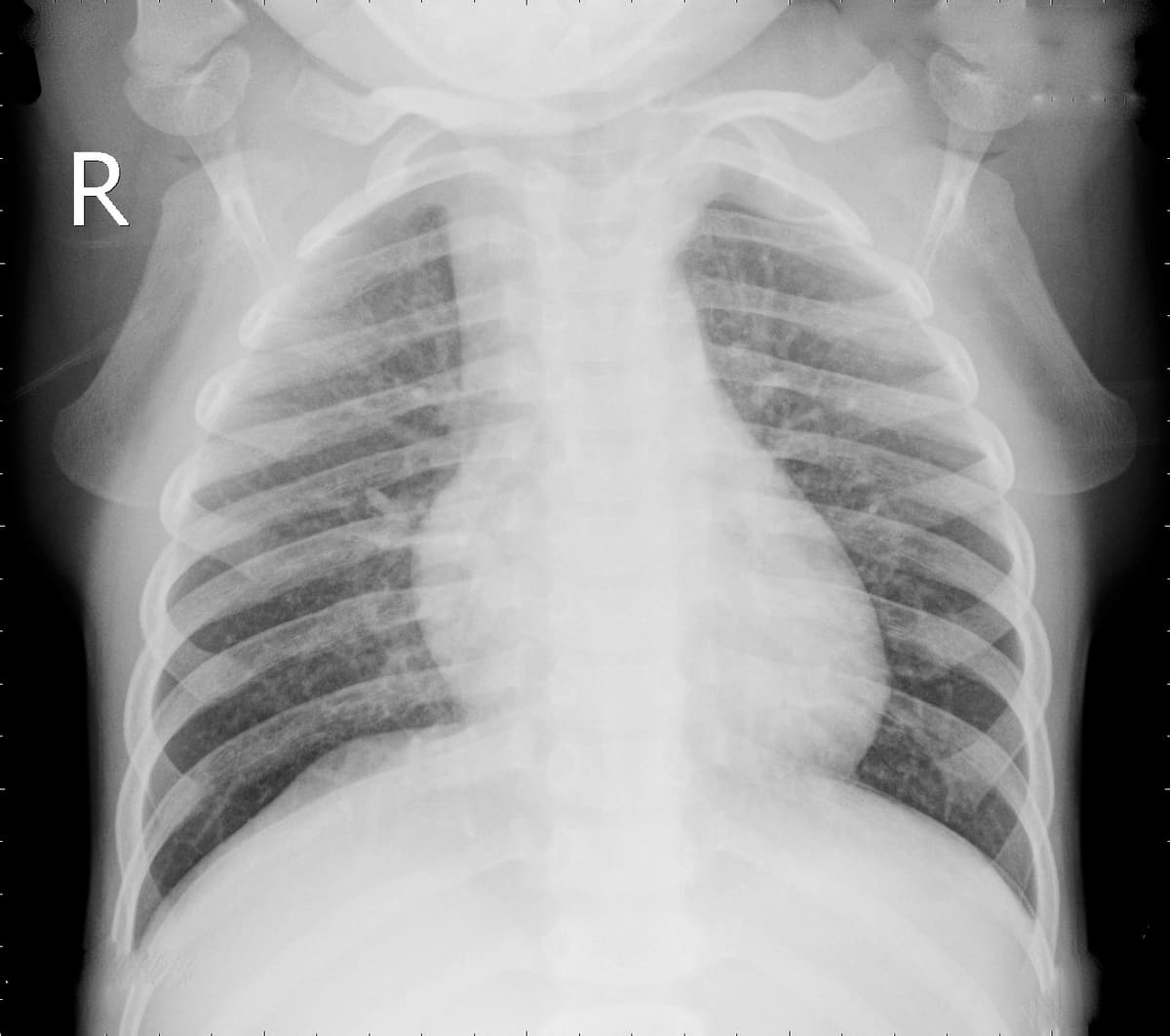 Radiografia Normal — NIH Chest X-ray14