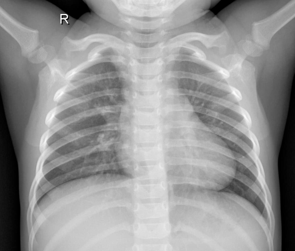 Radiografia Normal — NIH Chest X-ray14