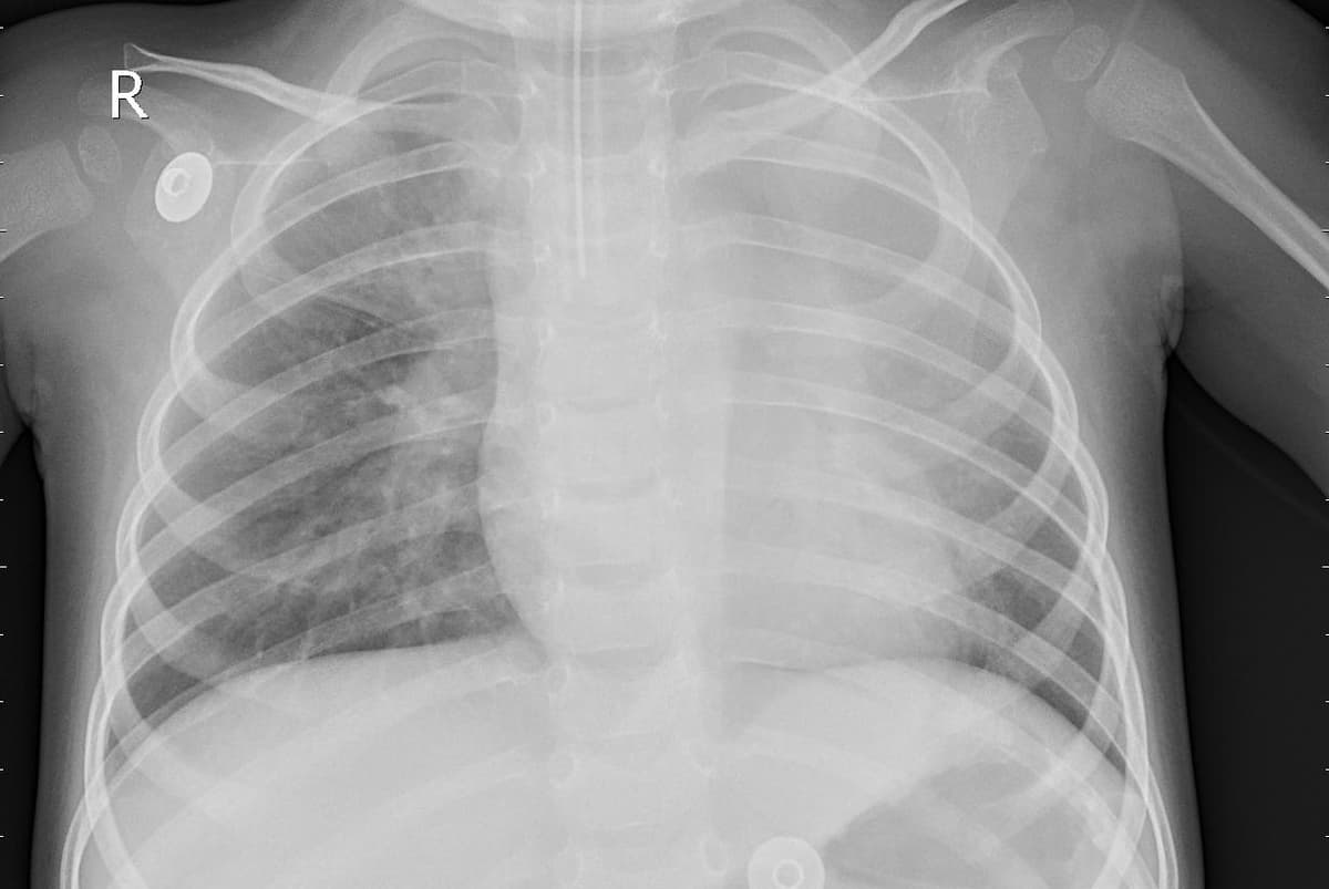 Pneumonia — NIH Chest X-ray14