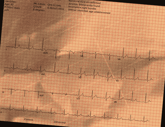 Normal ECG — PTB-XL