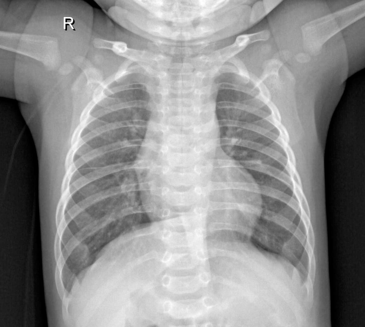 Radiografia Normal — NIH Chest X-ray14