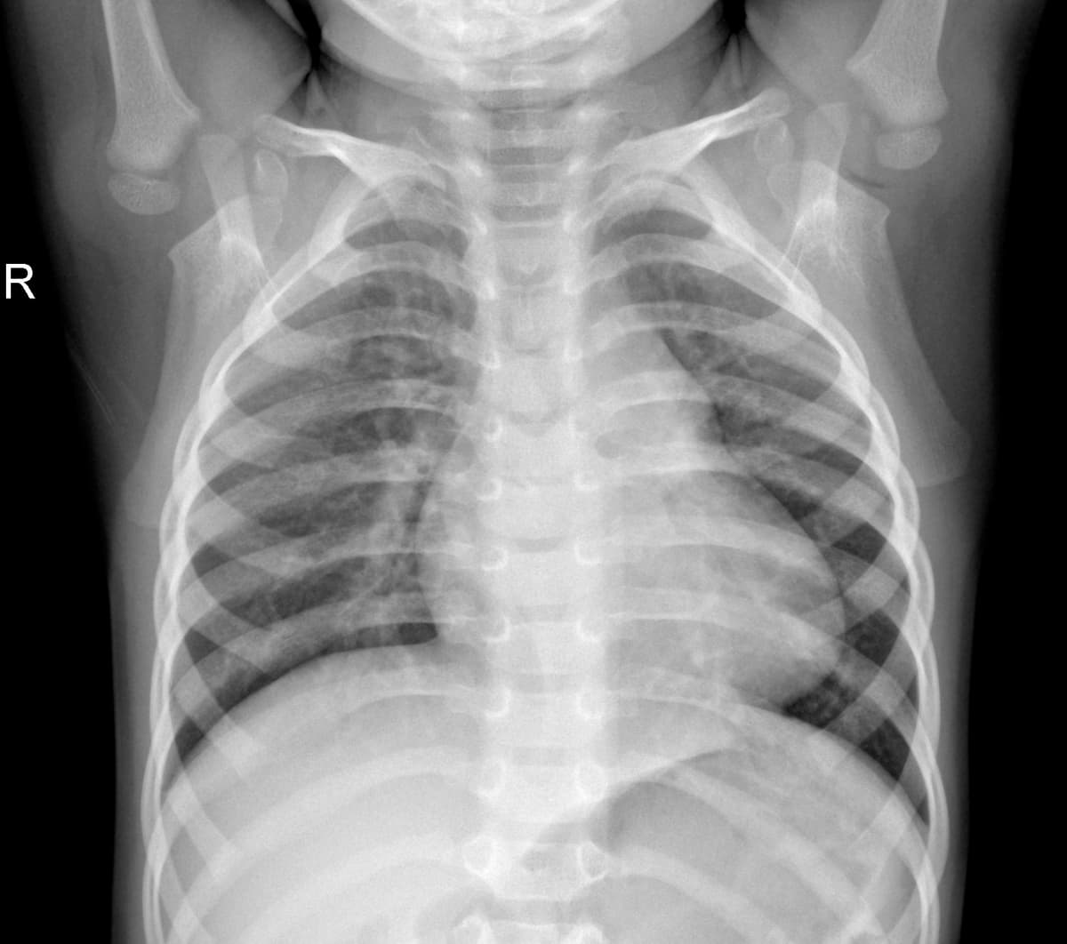 Radiografia Normal — NIH Chest X-ray14