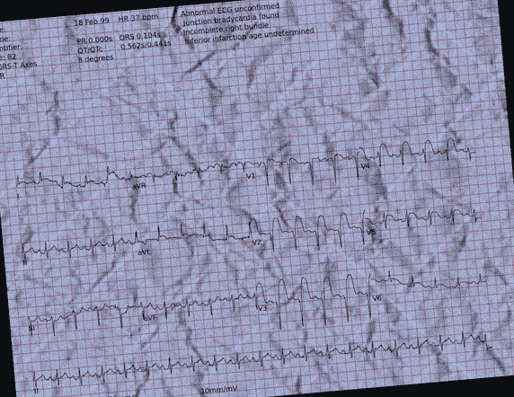 Normal ECG — PTB-XL