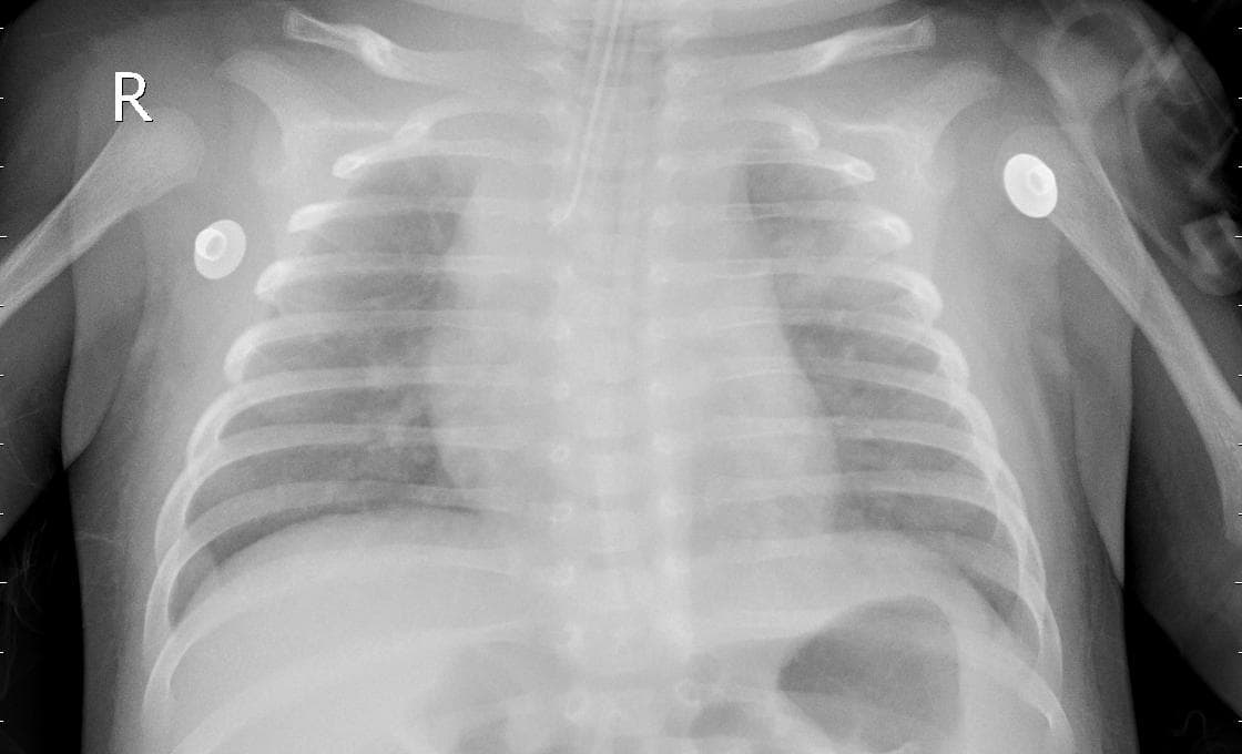 Pneumonia — NIH Chest X-ray14
