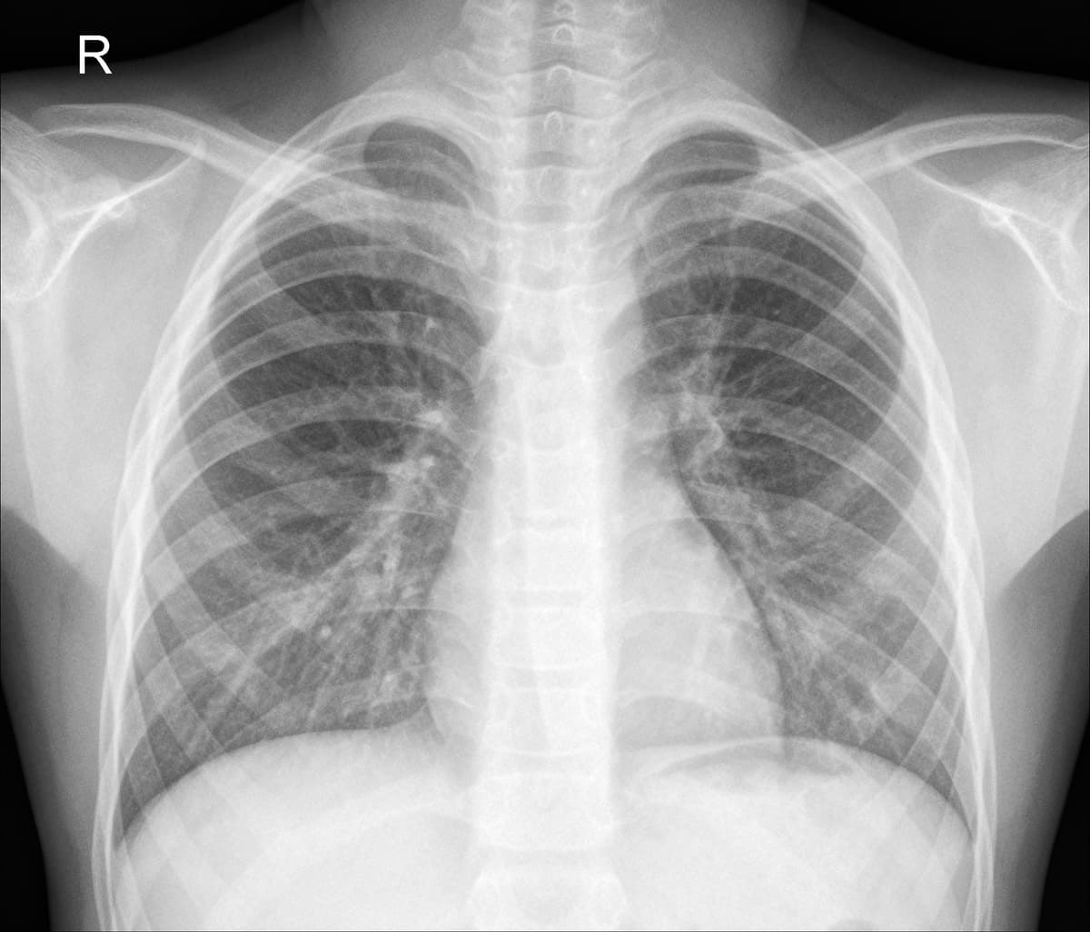 Radiografia Normal — NIH Chest X-ray14