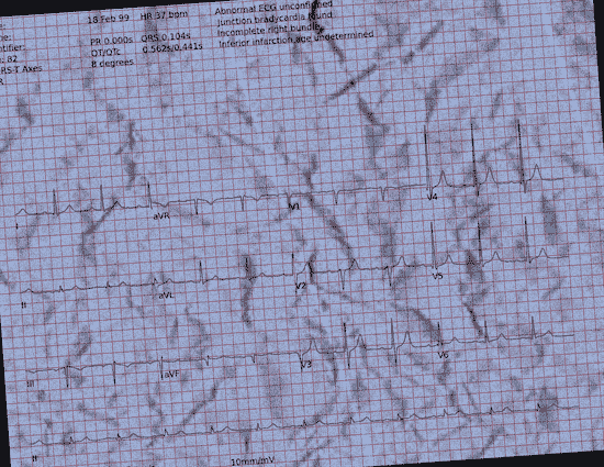 Normal ECG — PTB-XL