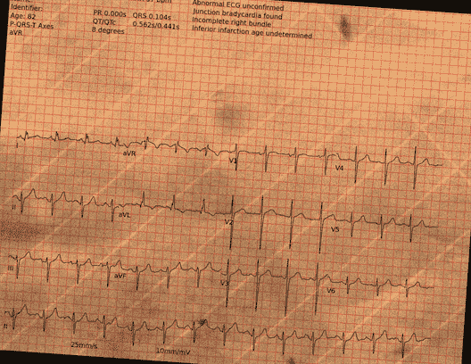 Normal ECG — PTB-XL