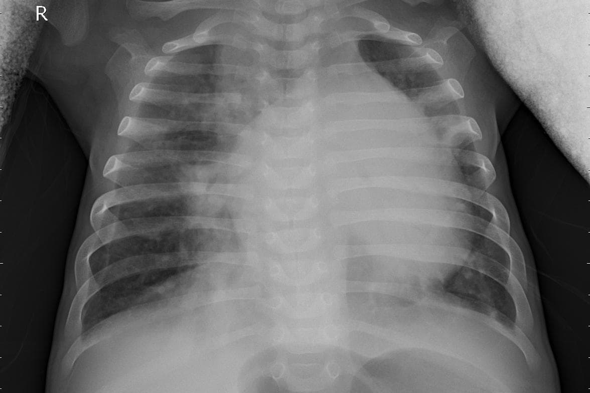 Pneumonia — NIH Chest X-ray14