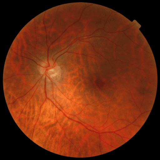 No Diabetic Retinopathy — MESSIDOR-2