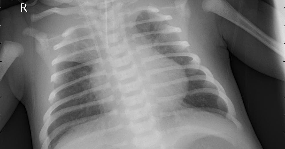 Pneumonia — NIH Chest X-ray14