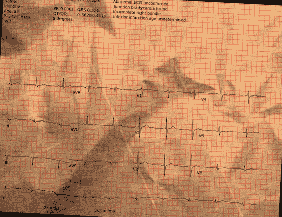 Normal ECG — PTB-XL