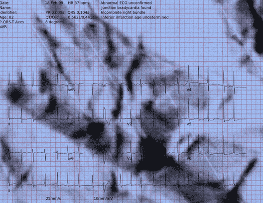 Normal ECG — PTB-XL