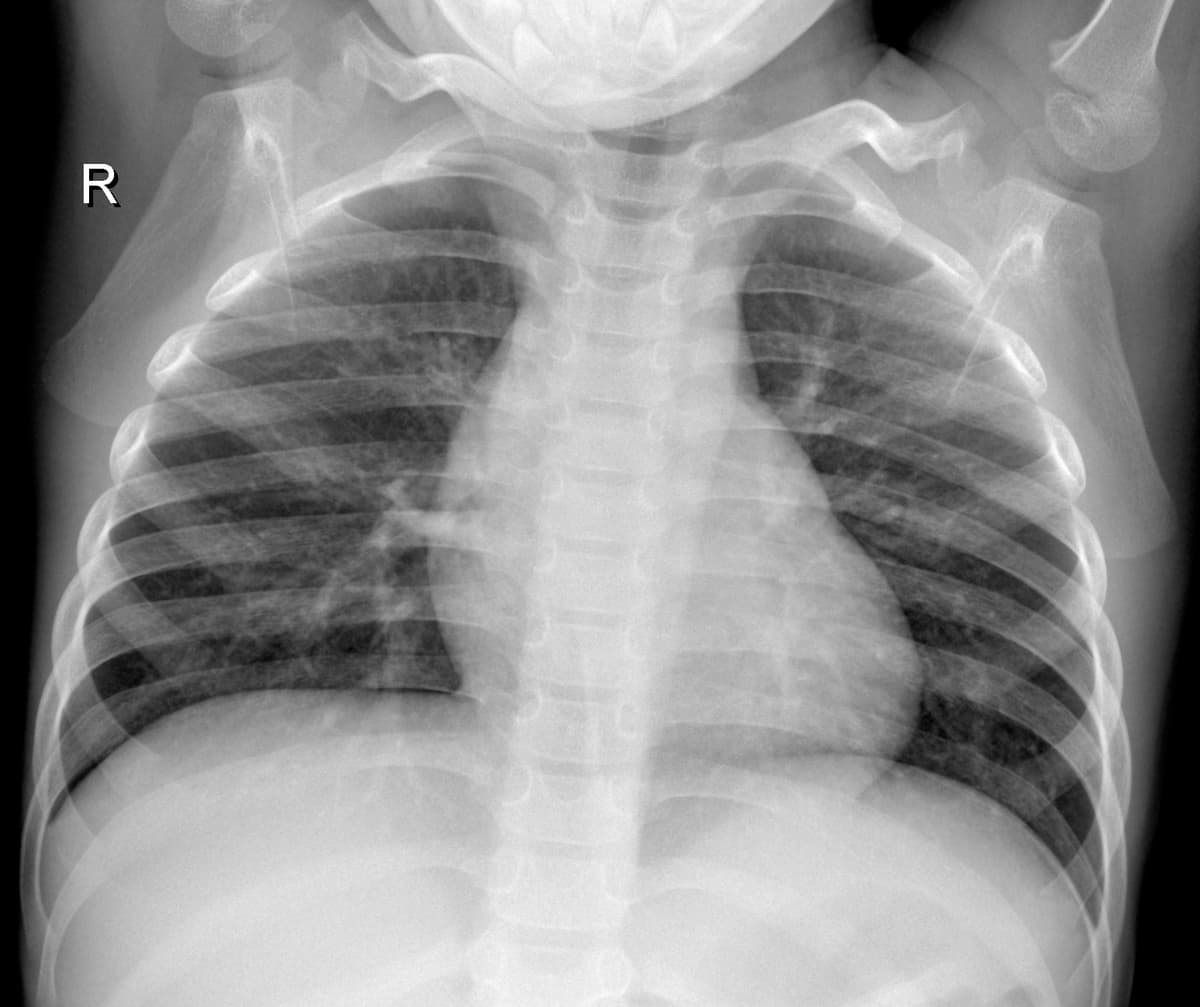 Radiografia Normal — NIH Chest X-ray14