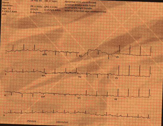 Normal ECG — PTB-XL