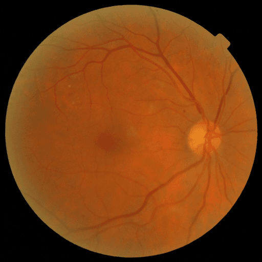 No Diabetic Retinopathy — MESSIDOR-2