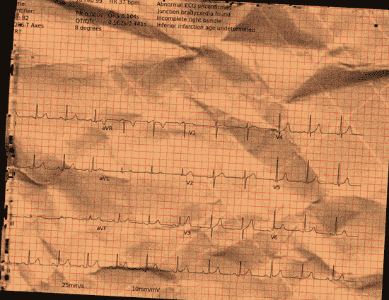 Normal ECG — PTB-XL