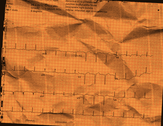 Normal ECG — PTB-XL