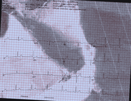 Normal ECG — PTB-XL