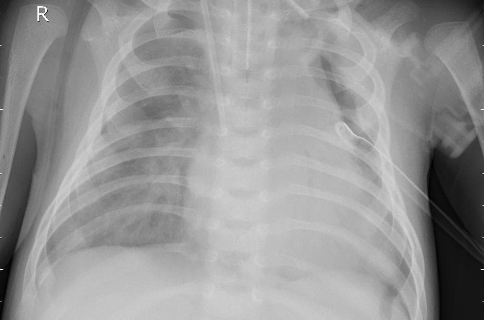 Pneumonia — NIH Chest X-ray14