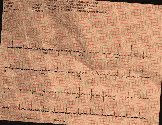 Normal ECG — PTB-XL