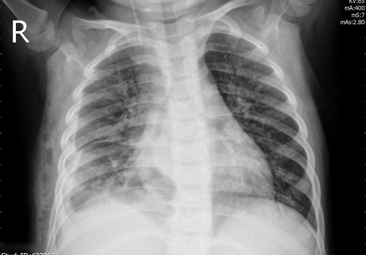 Pneumonia — NIH Chest X-ray14