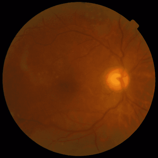 No Diabetic Retinopathy — MESSIDOR-2