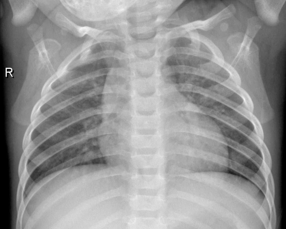 Radiografia Normal — NIH Chest X-ray14