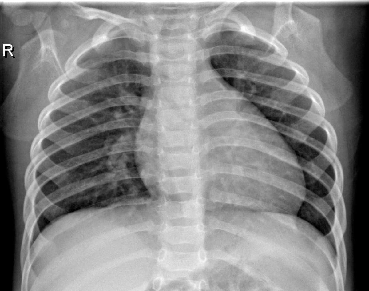 Radiografia Normal — NIH Chest X-ray14