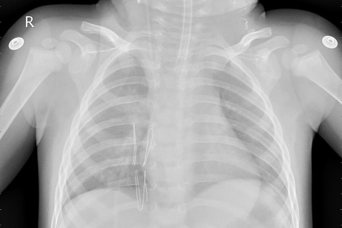 Pneumonia — NIH Chest X-ray14