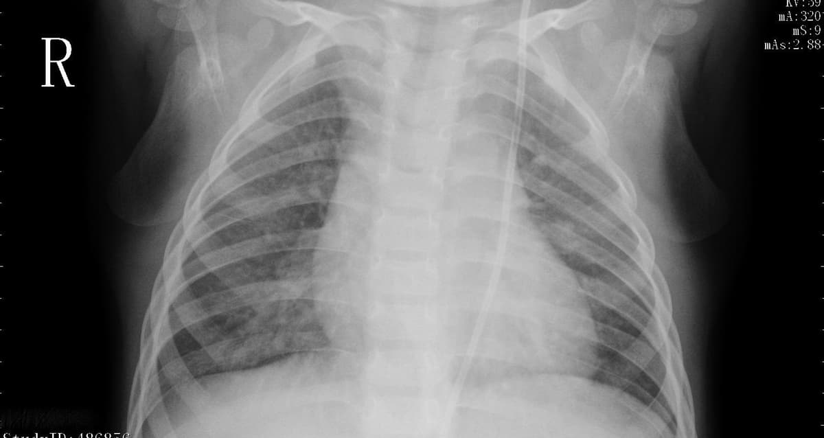 Pneumonia — NIH Chest X-ray14
