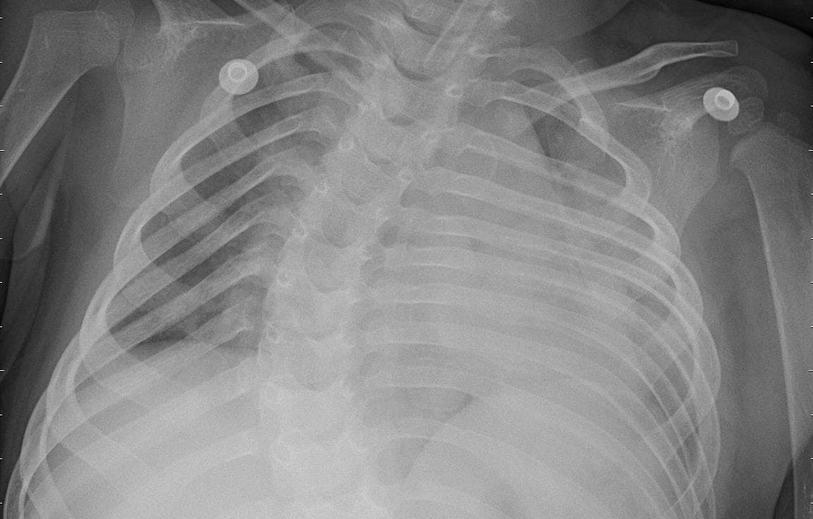 Pneumonia — NIH Chest X-ray14