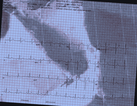Normal ECG — PTB-XL