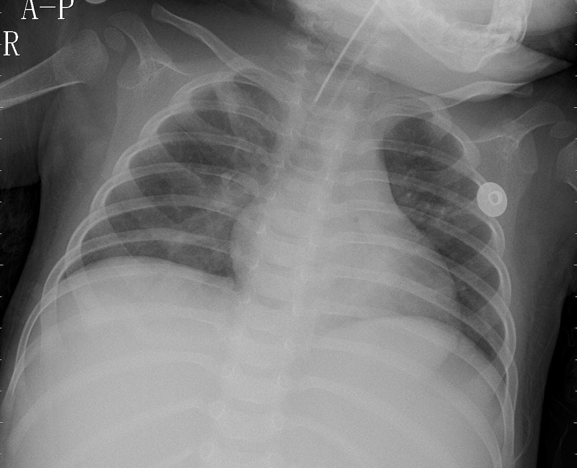 Pneumonia — NIH Chest X-ray14