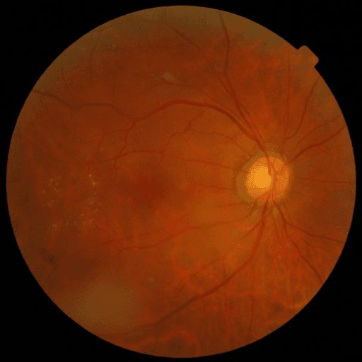 Proliferative DR — MESSIDOR-2