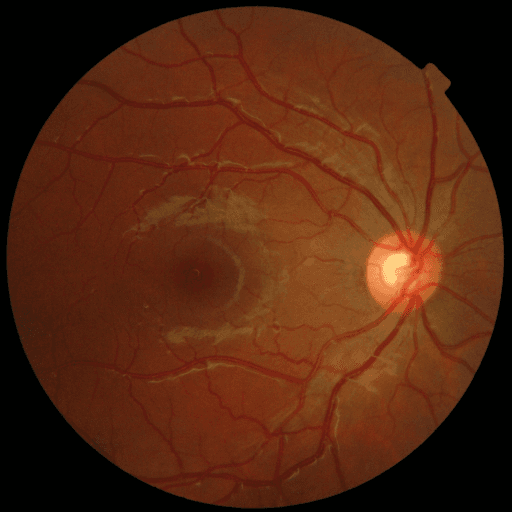 No Diabetic Retinopathy — MESSIDOR-2