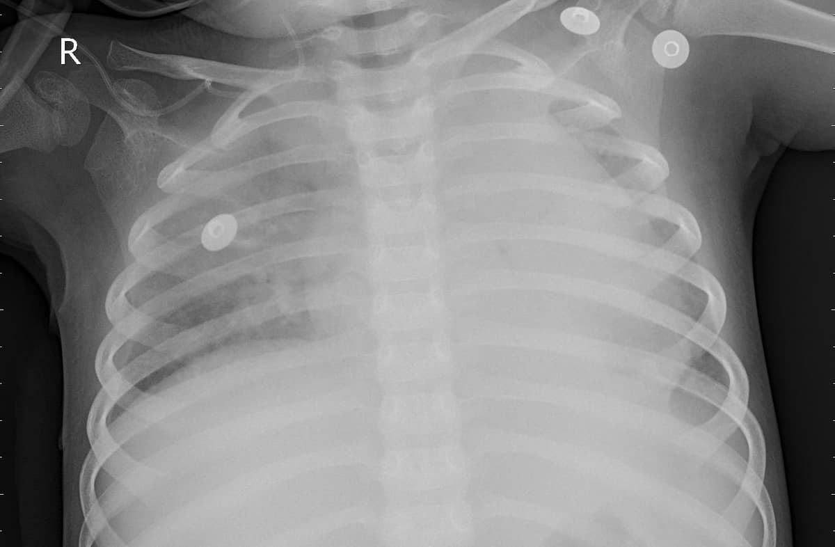 Pneumonia — NIH Chest X-ray14
