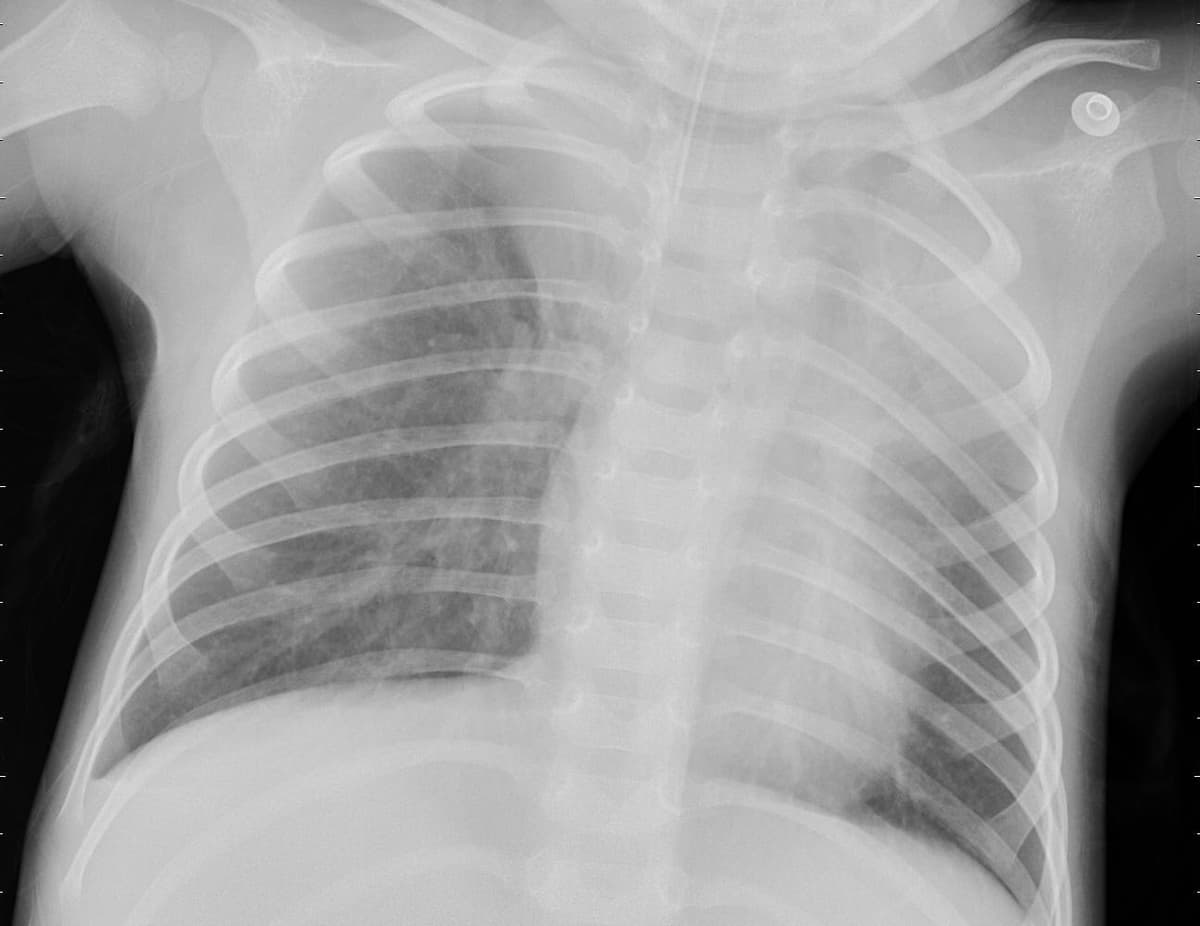 Pneumonia — NIH Chest X-ray14